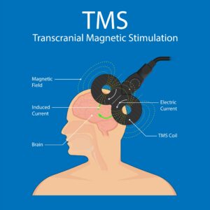 Success rate of TMS therapy